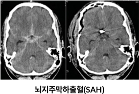 뇌지주막하출혈(SAH) 이미지
