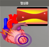 협심증