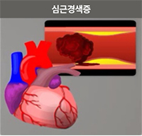 심근경색