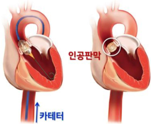 대동맥판막