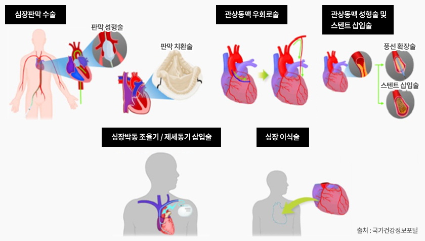 심부전