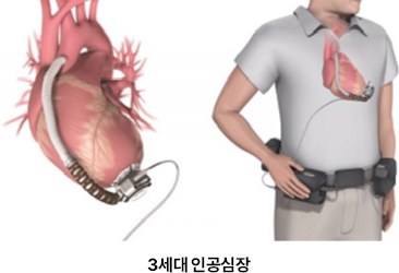 인공심장이식수술 LVAD(좌심실 보조 장치)