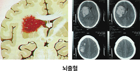 뇌출혈