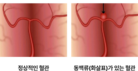 정상 혈관과 동맥류 혈관