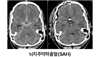 뇌자주막하출혈(SAH)