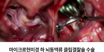 마이크로현미경 하 뇌동맥류 클립결찰술 수술