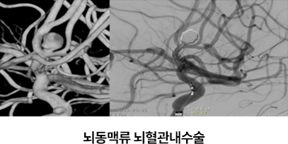 뇌동맥류 뇌혈관내수술