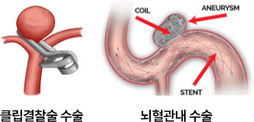 뇌혈관내수술