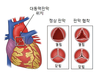 대동맥 판막 협착