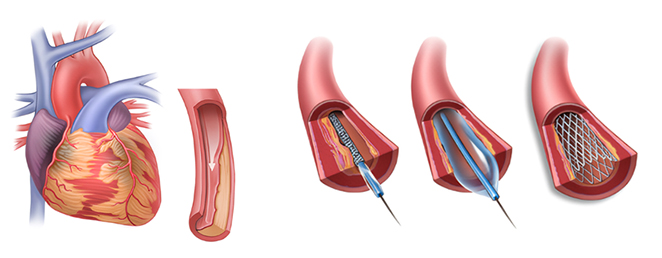 관상동맥중재술